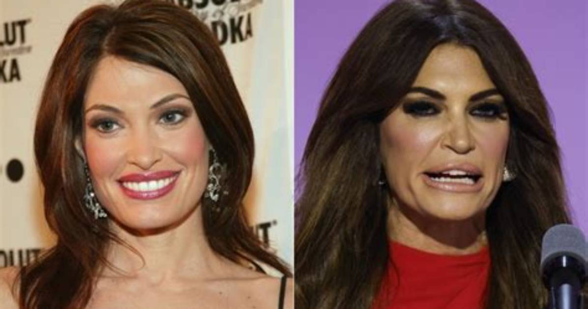 Astonishing Kimberly Guilfoyle's Lip Injection Transformation: Before and After