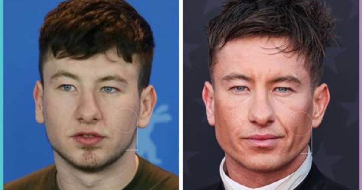 Barry Keoghan Plastic Surgery: Before and After Transformation