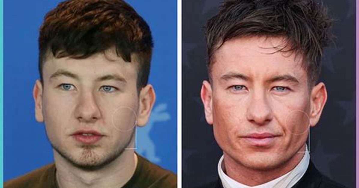 Barry Keoghan's Plastic Surgery: a Look at His Transformation