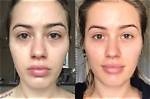Before & After Pics — Did She Remove Implants? – Hollywood Life