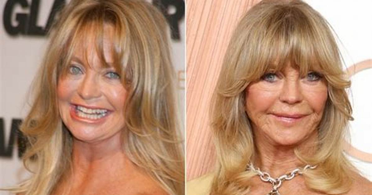Did Goldie Hawn Resort to Plastic Surgery? the Answers You Seek