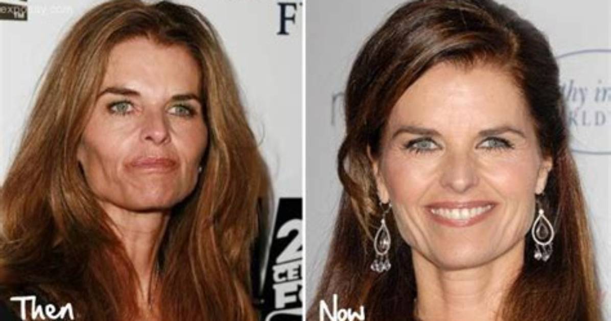 Has Maria Shriver Had Plastic Surgery? Facelift and Cosmetic Surgery Update ·