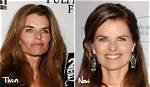 Has Maria Shriver Had Plastic Surgery? Facelift and Cosmetic Surgery Update ·