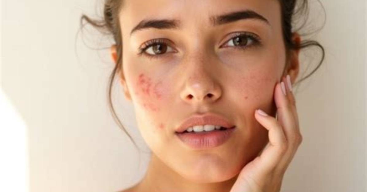 If Your Skin Is Breaking Out, These Pimple Patches with over 32,500 Reviews Are Under $20
