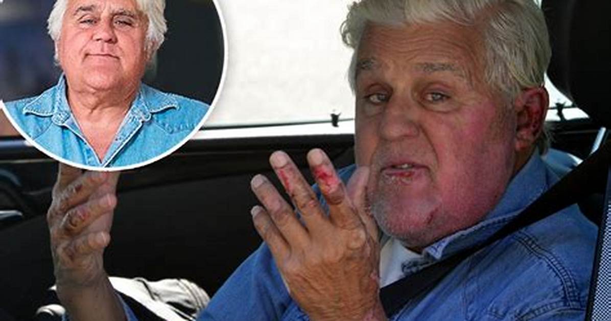 Jay Leno Reveals Face & Hand Scars, Seen Driving Cadillac: Photos – Hollywood Life