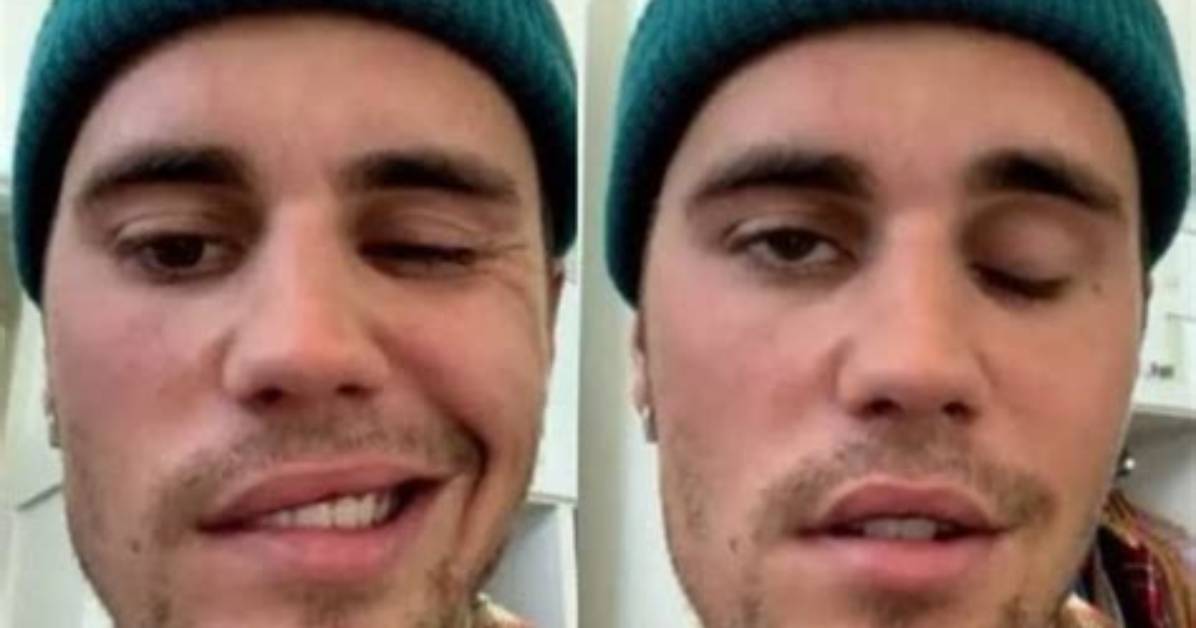 Justin Bieber’s Face Is Paralyzed Due to Ramsay Hunt Syndrome – Hollywood Life