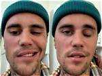 Justin Bieber’s Face Is Paralyzed Due to Ramsay Hunt Syndrome – Hollywood Life