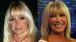 Know About Suzanne Somers Plastic Surgery With
