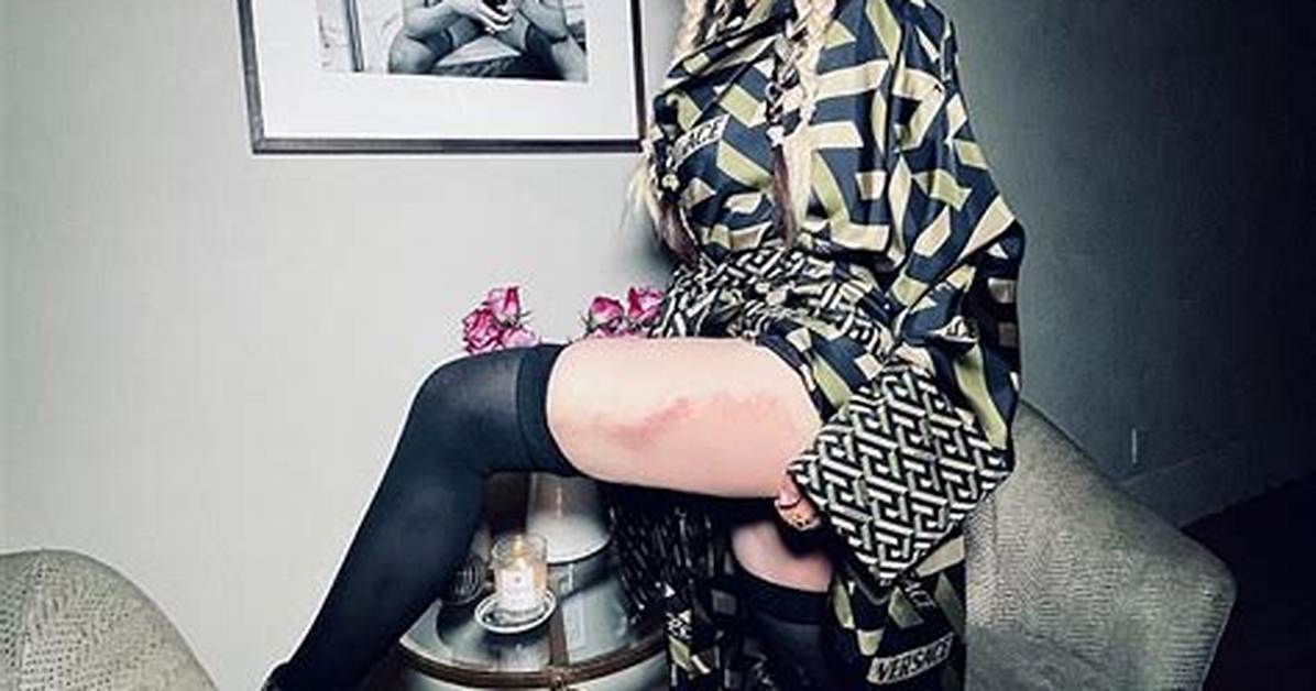 Madonna Reveals Massive Bruise Down Her Entire Thigh While Rocking Versace in New Photos
