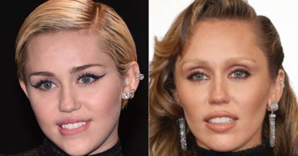Miley Cyrus Buccal Fat Removal: Before and After Photos