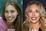 [Pics] Chloe Lattanzi’s Plastic Surgery Before & After Pics: – Hollywood Life