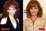 Reba Mcentire Plastic Surgery: Before and After Photo