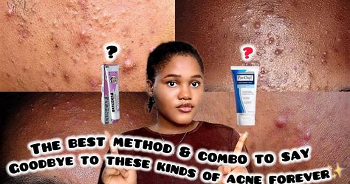Say Goodbye to Acne with These Best-Selling Preventative Products All Around $15